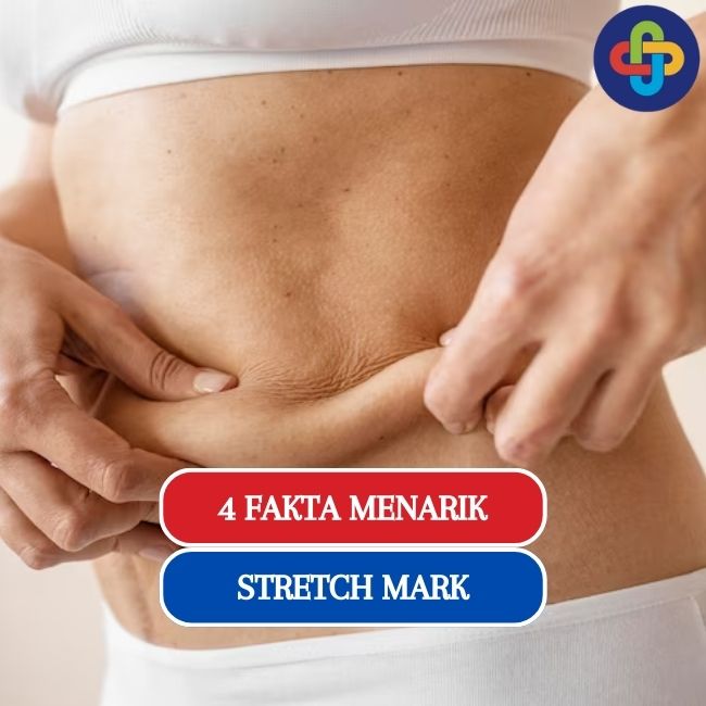 Fakta Menarik Stretch Mark, yang Perlu Kamu Tahu